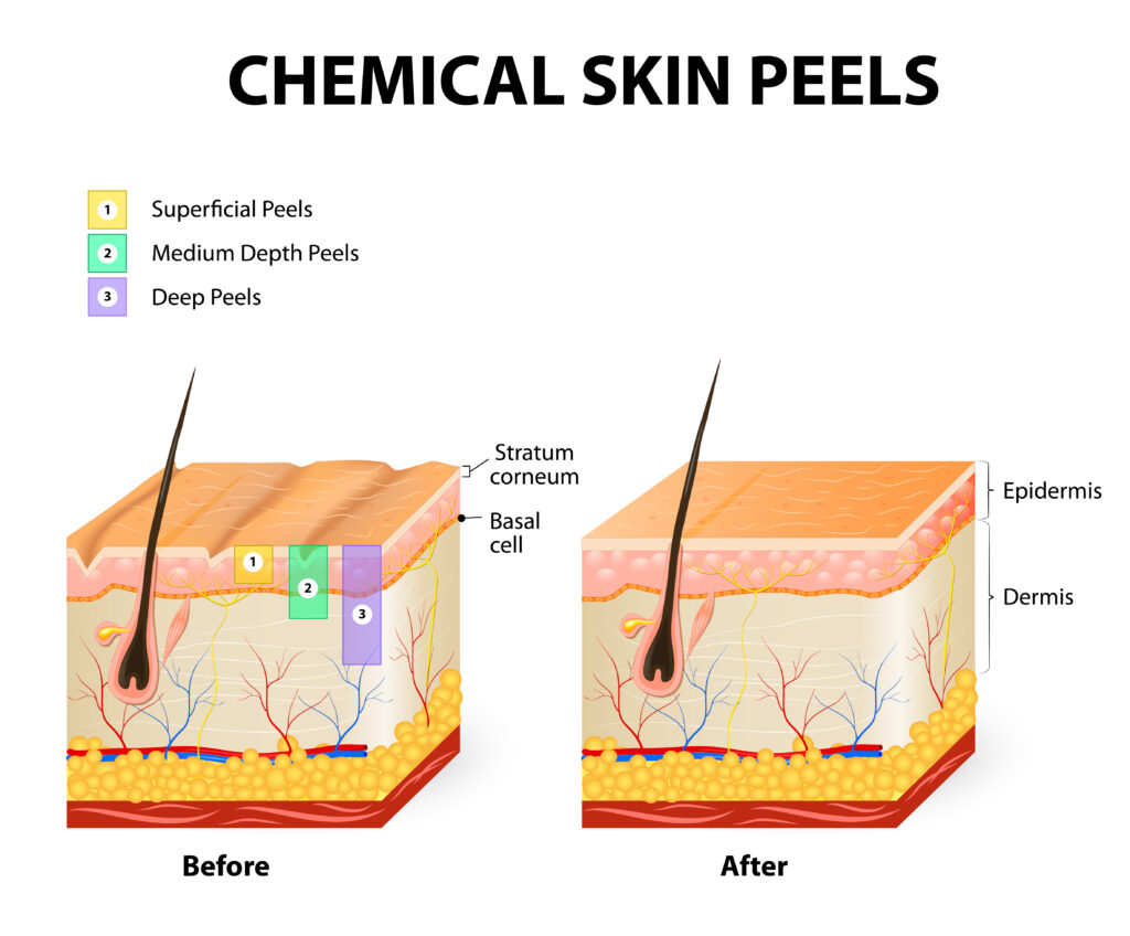 表皮と真皮の違いを示した皮膚の解剖図